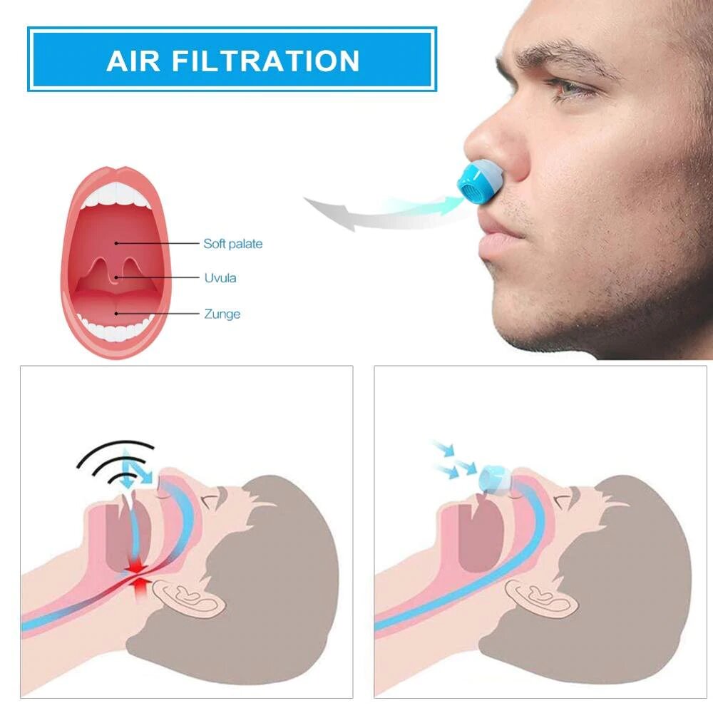 Sisica | Anti-Snoring Device | Tubeless, Maskless Micro-CPAP