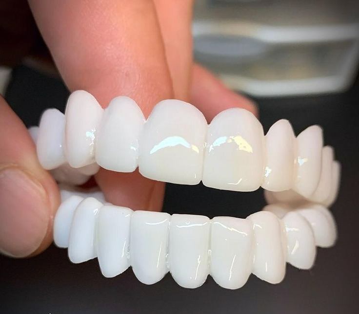 Charly | DentAlign Dental Veneers – Natural Fit and Comfort