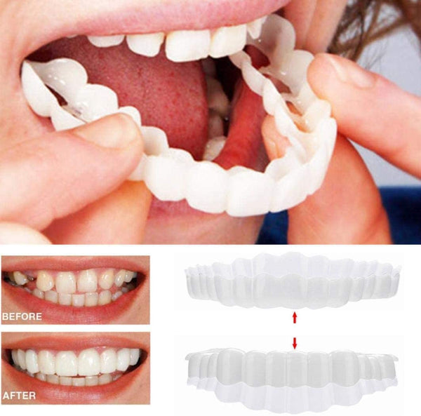 Charly | On Smile Veneers (Upper and Lower Jaw included)