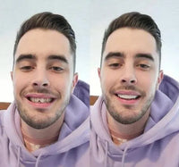 Sisica | On Smile Veneers (Upper and Lower Jaw included)