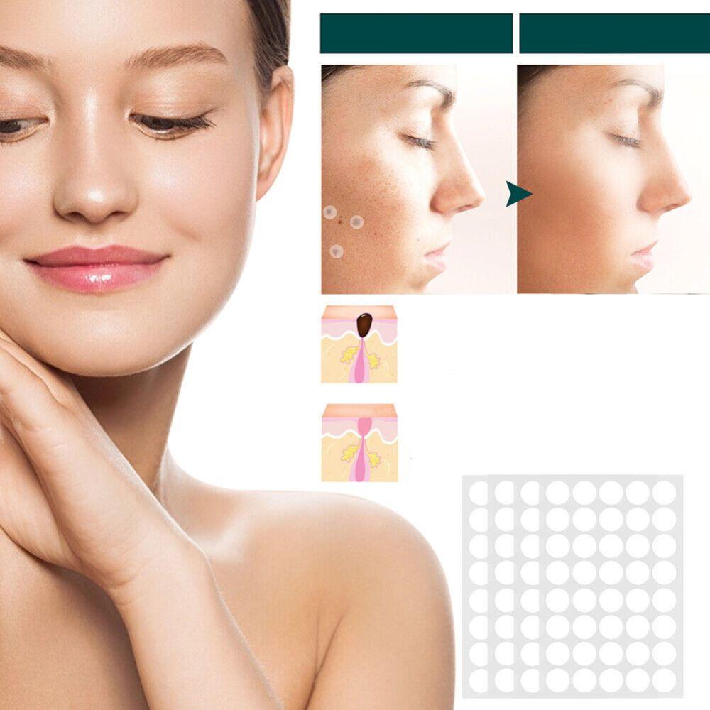 Sisica | SkinClear Skin Tag Remover | Plaster for the Removal of Skin Tags & Warts | Hydrocolloid Technology | Pain-Free & Discreet | Suitable for All Skin Types | 144 Pieces