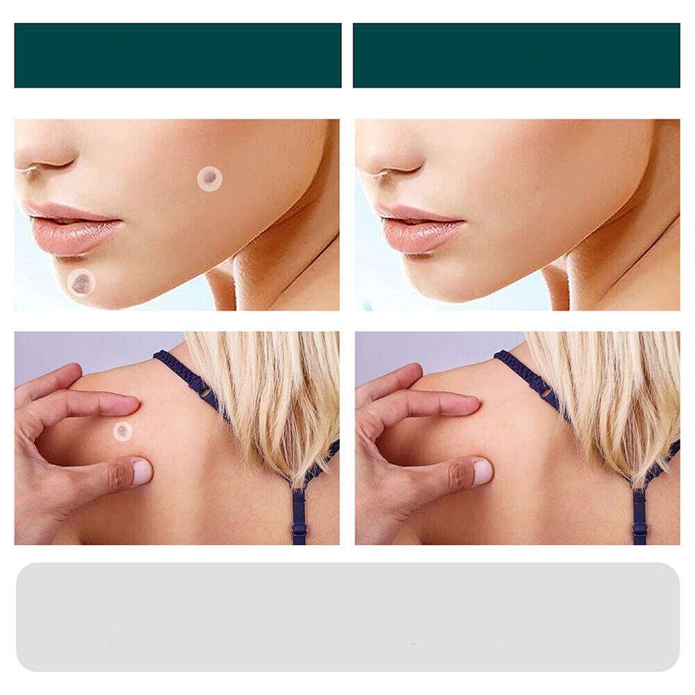 Sisica | SkinClear Skin Tag Remover | Plaster for the Removal of Skin Tags & Warts | Hydrocolloid Technology | Pain-Free & Discreet | Suitable for All Skin Types | 144 Pieces