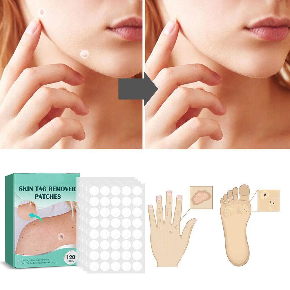 Sisica | SkinClear Skin Tag Remover | Plaster for the Removal of Skin Tags & Warts | Hydrocolloid Technology | Pain-Free & Discreet | Suitable for All Skin Types | 144 Pieces