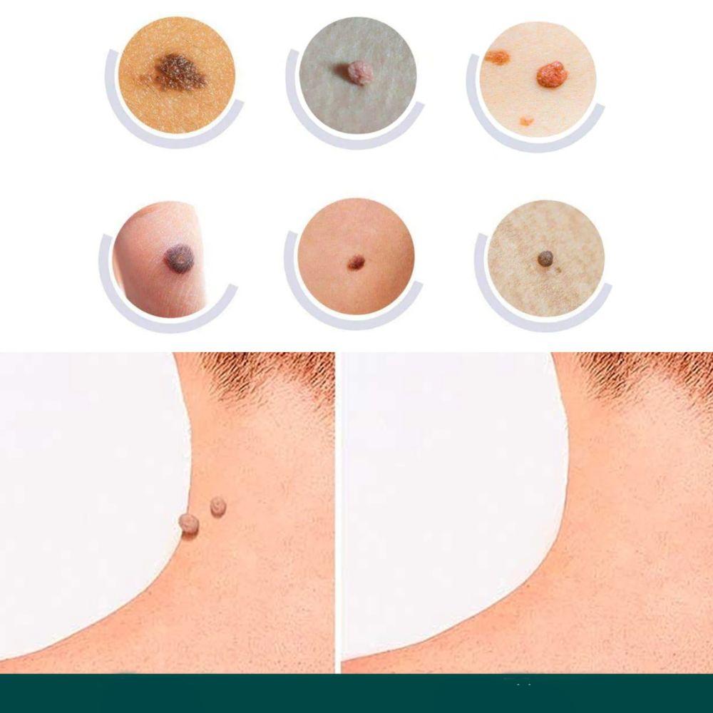 Sisica | SkinClear Skin Tag Remover | Plaster for the Removal of Skin Tags & Warts | Hydrocolloid Technology | Pain-Free & Discreet | Suitable for All Skin Types | 144 Pieces